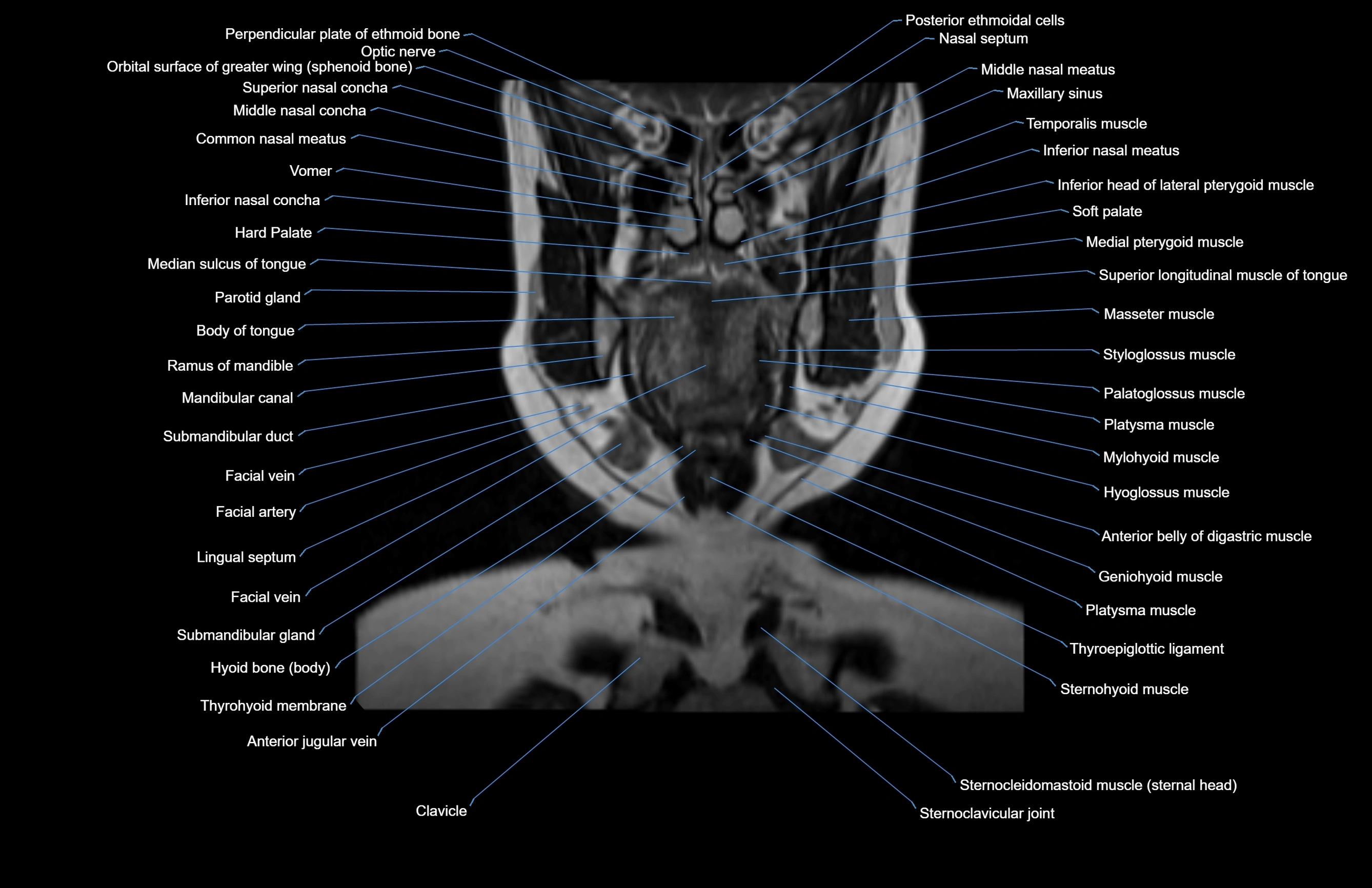 Neck coronal cross sectional MRI anatomy 3T MRI  image-img-00001-00052.webp